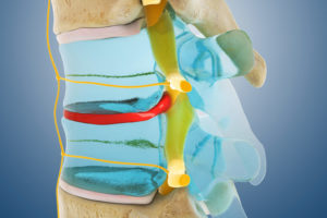 Spinal Decompression for Spondylolisthesis
