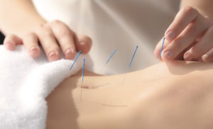 Acupuncture for Infertility