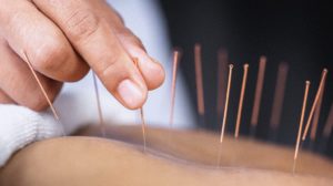 Acupuncture Before Surgery May Help Reduce Opioid Use Afterward