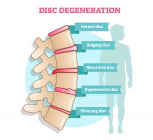 Pain Relief for Herniated Disc