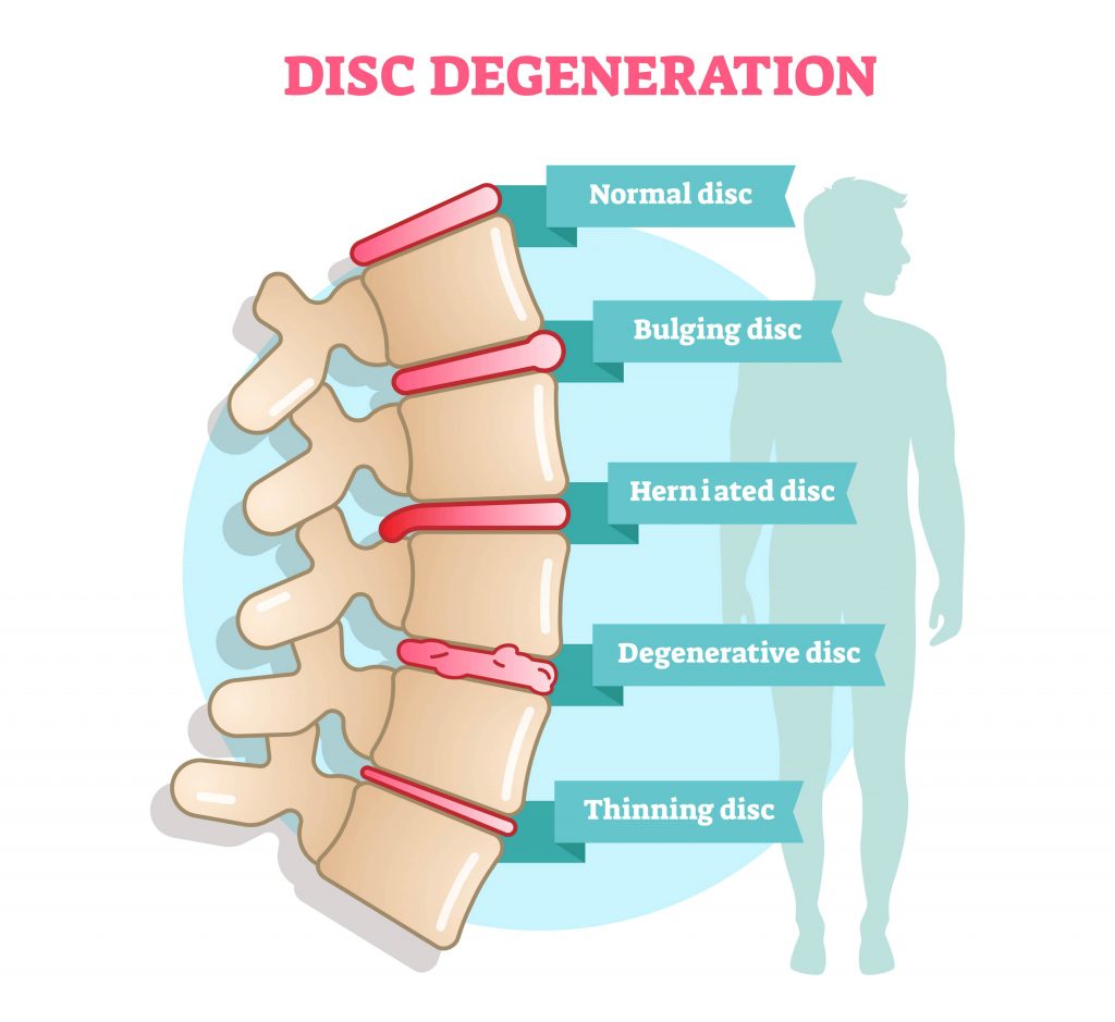 Get Pain Relief from a Herniated Discs