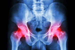 Therapeutic Injections for Osteoarthritis of the Hip