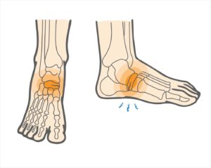 What To Know About Stress Fractures