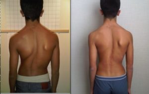 What Are The Early Signs Of Scoliosis?