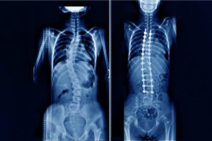 Things To Consider Before Scoliosis Surgery For EDS