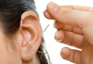 Acupuncture Before Surgery: How Does It Help?