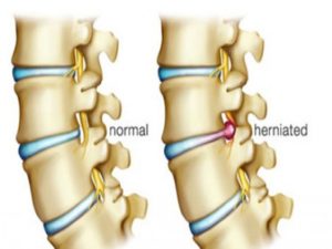 Alternative Treatments for Disc Herniation