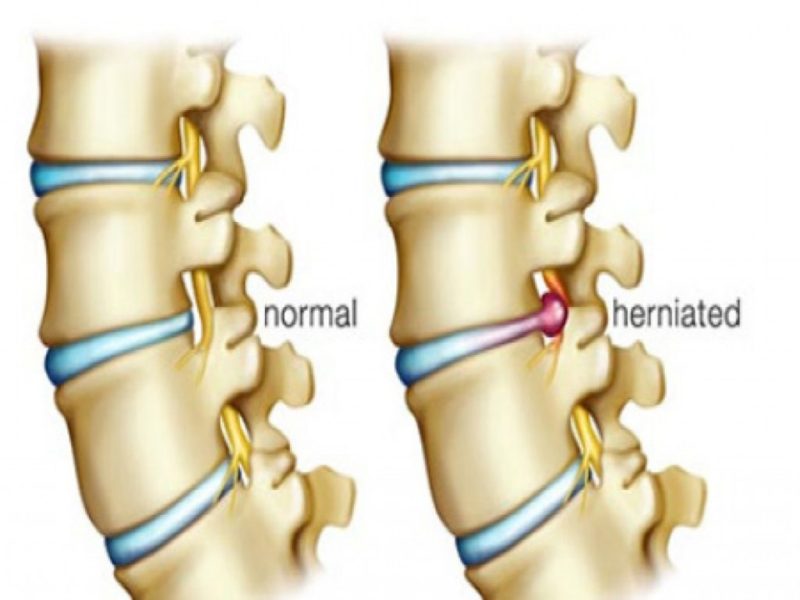 Alternative Treatments for Disc Herniation Premierechiro