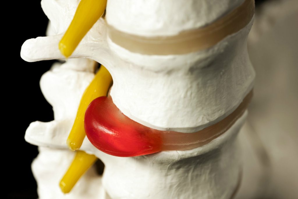 Chiropractic Care For Herniated Disc Premierechiro