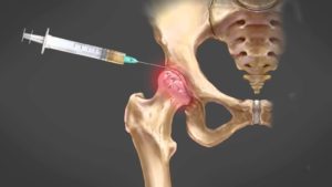 PRP Injections for Hip Pain