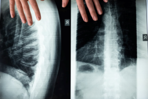 What You Should Know About Scoliosis and Chiropractic Treatments