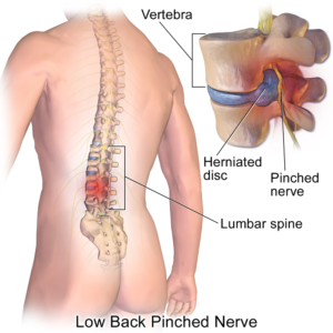 Chiropractic Treatment: Ways of Treating a Pinched Nerve