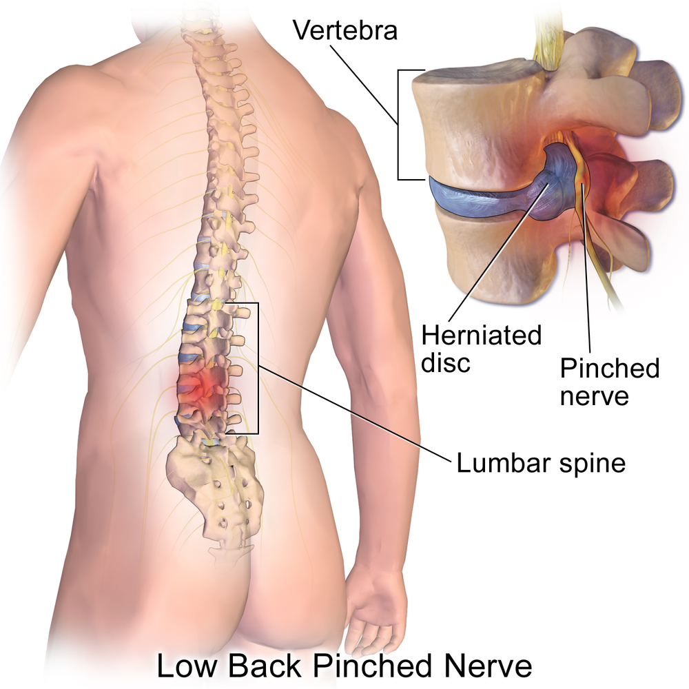 Chiropractic Treatment: of Treating Pinched - Premierechiro