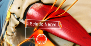 Getting Sciatic Pain Relief