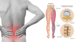 Sciatic Nerve Anatomy