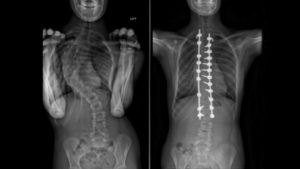 New scoliosis surgery gives hope to retain mobility